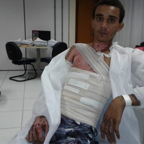 Jovem teve corpo queimado pela parceira no dia dos namorados em Feira de Santana