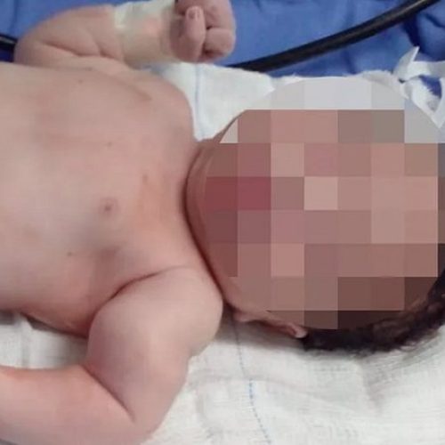 Bebê tem braço quebrado durante parto em Salvador