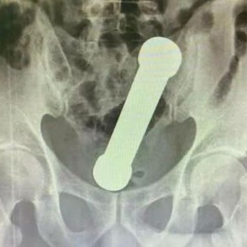 Homem é hospitalizado após introduzir peso de academia no reto